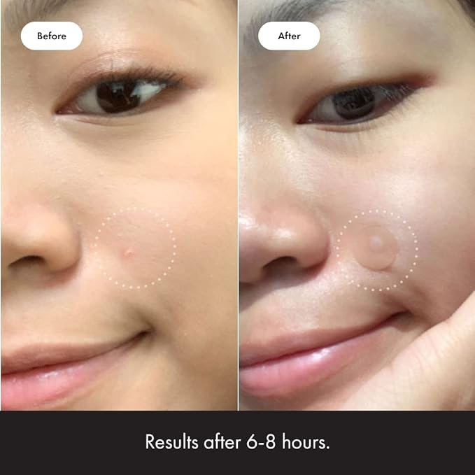Mighty Patch Original – Hydrocolloid Acne Patches, 36 Ct.